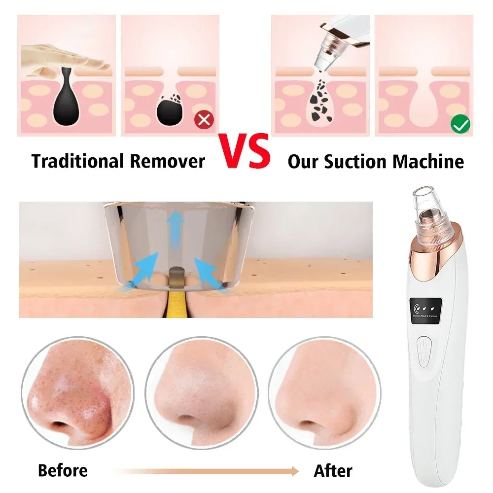 ✨ Electric Blackhead Remover Vacuum – USB Rechargeable Facial Pore Cleaner Deep, Painless, and Effective Skincare at Home